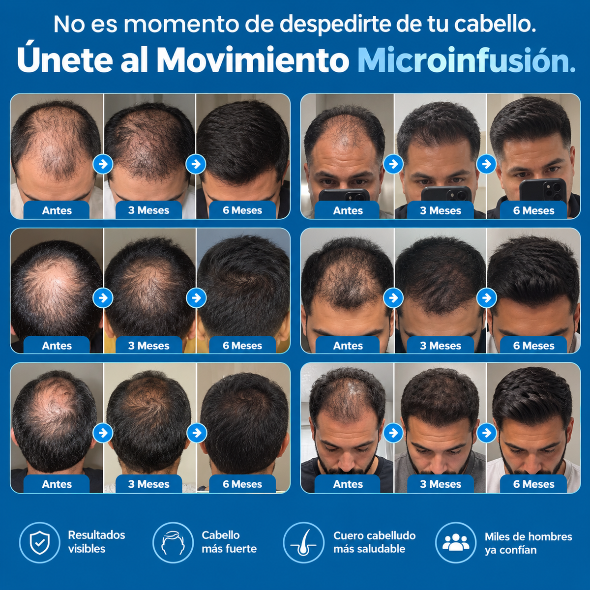 Microinfusión Capilar Pro – Tratamiento Avanzado para el Cabello