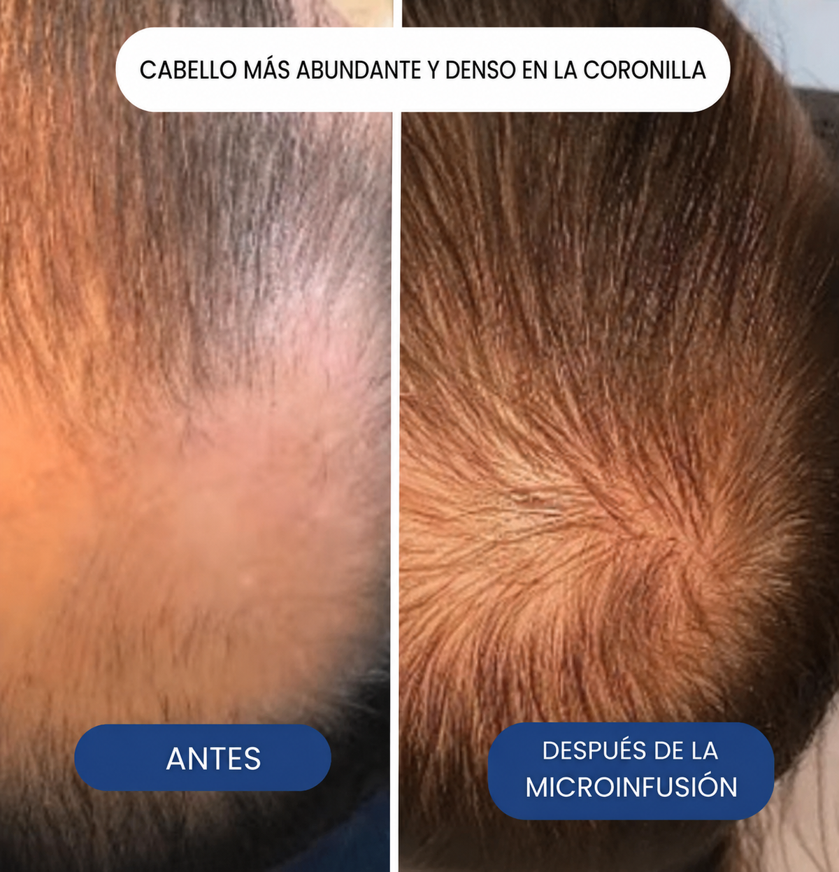 Microinfusión Capilar Pro – Tratamiento Avanzado para el Cabello